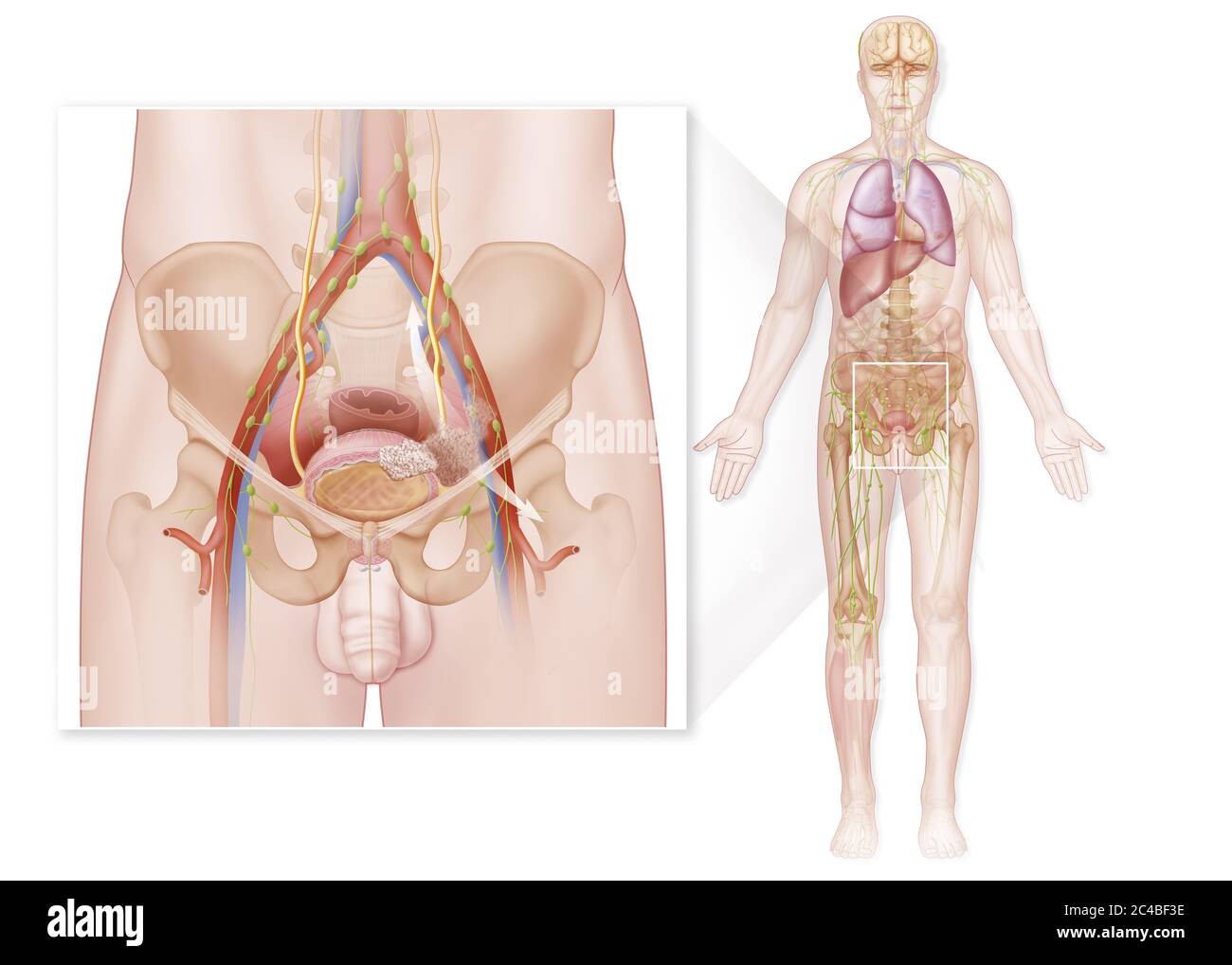 Stadio IV cancro della vescica nell'uomo, invasione tumorale con metastasi. L'illustrazione a destra del disegno rappresenta l'anatomia generale in un ma Foto Stock