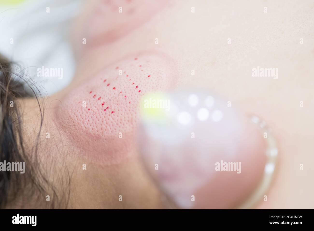 Hijama - il trattamento del sangue. Coppa a vuoto collegata. Processo di scarificazione. Foto Stock