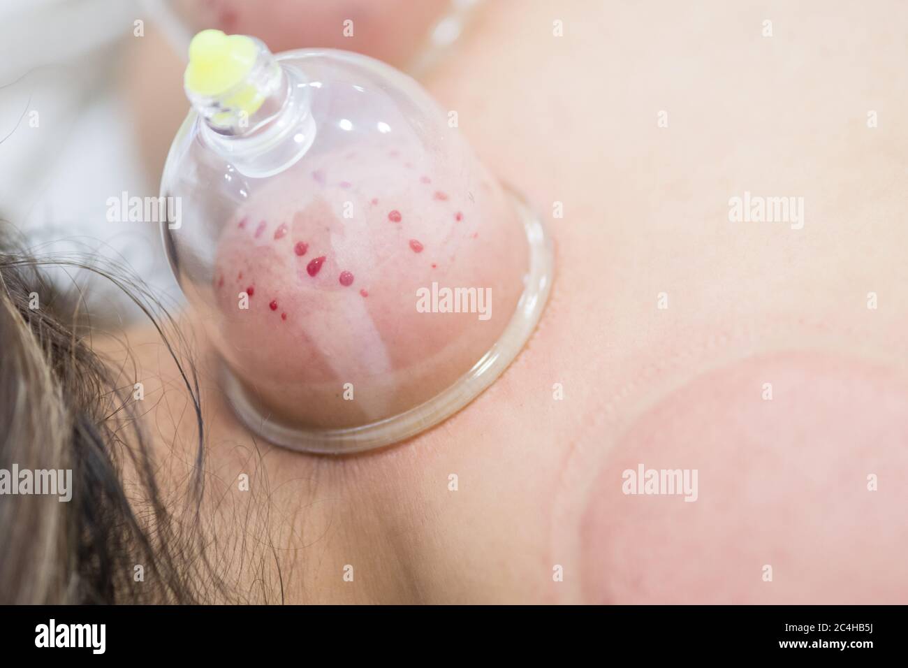 Hijama - il trattamento del sangue. Coppa a vuoto collegata. Processo di scarificazione. Foto Stock