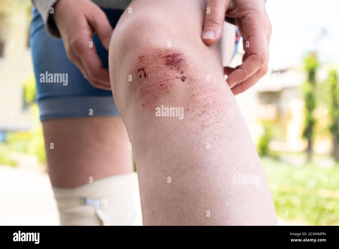 Open wound on leg immagini e fotografie stock ad alta risoluzione - Alamy