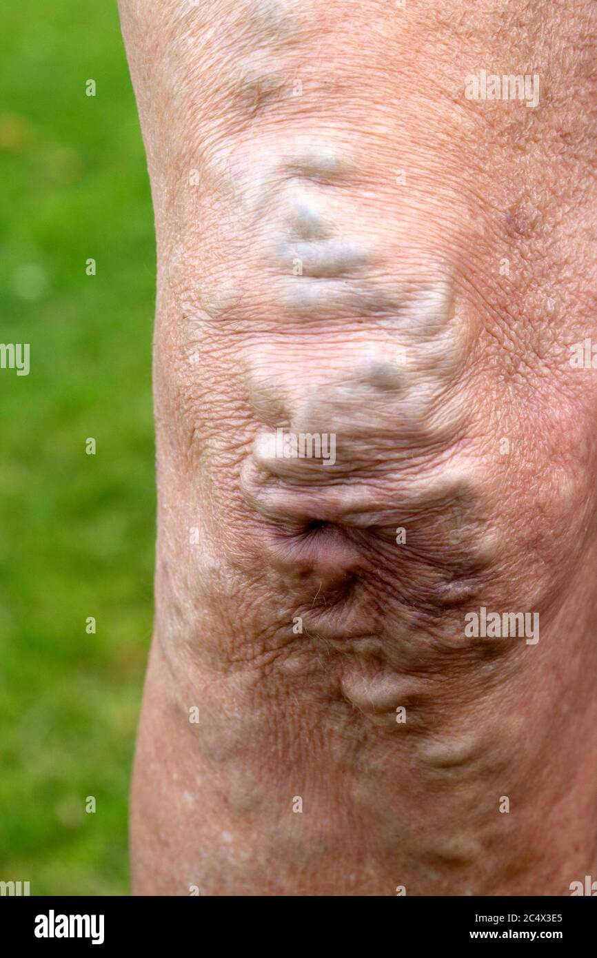 Vene varicose gonfie sul ginocchio della donna anziana UK Foto Stock