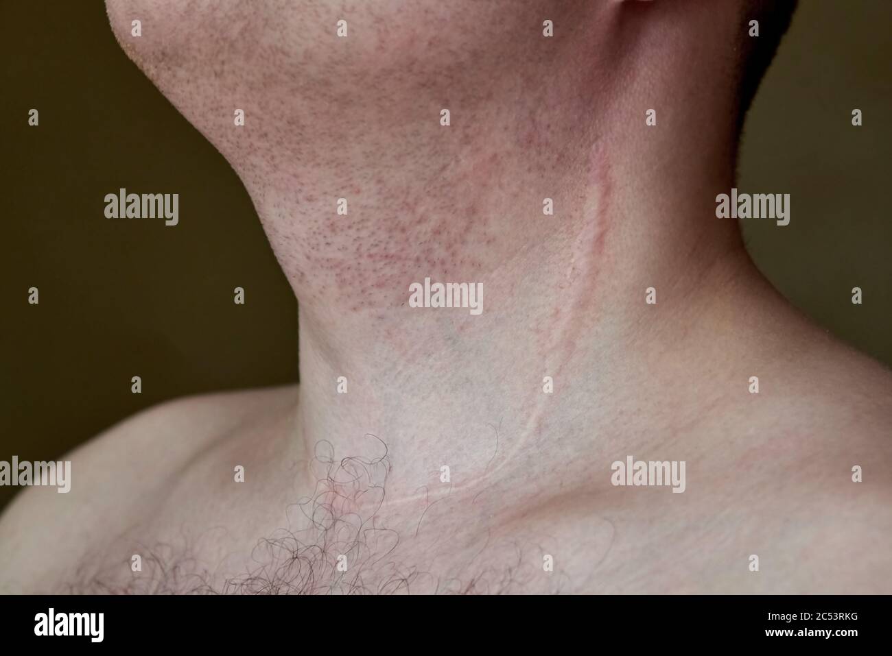 Cicatrice sul collo di un uomo dopo la rimozione della ghiandola tiroidea,  primo piano Foto stock - Alamy