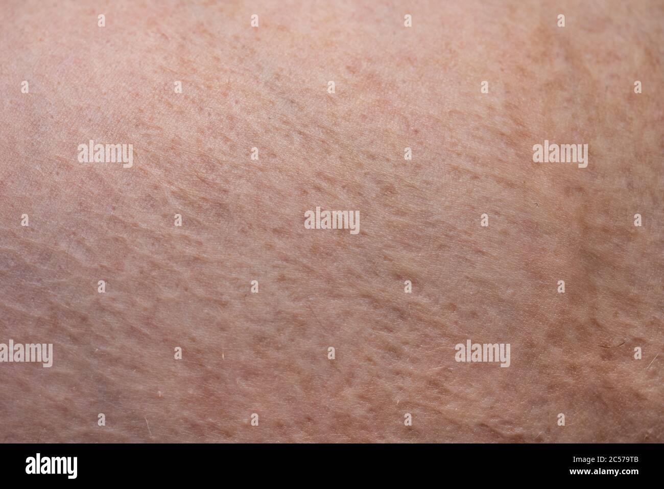Foto della pelle dell'uomo con bruciature cicatrizzate, foto di primo piano Foto Stock