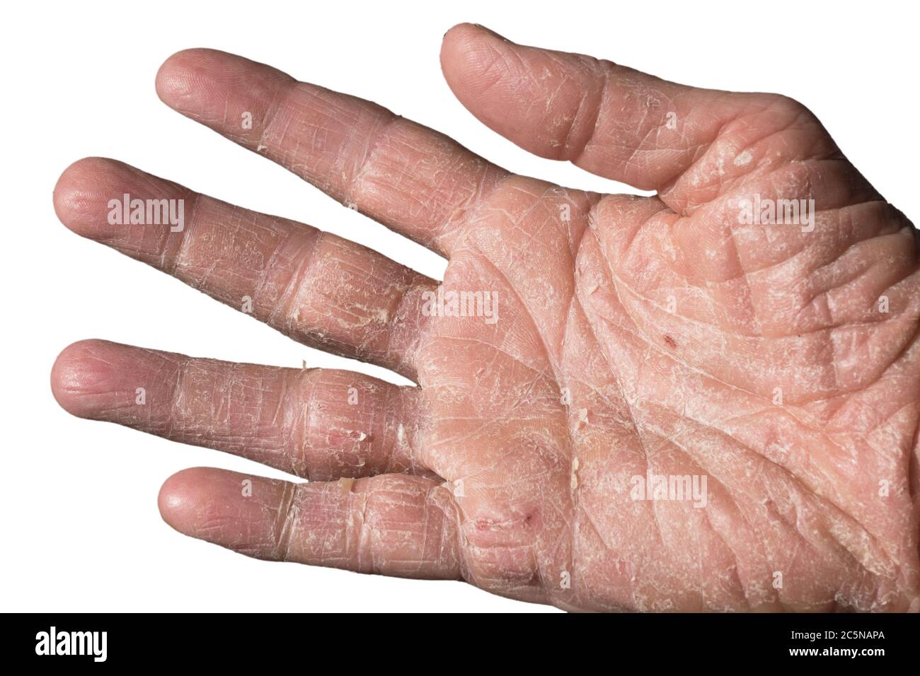 Eczema con arrossamento, rigonfiamenti, protuberanze e fiocchi sulla mano e  sulle dita di un uomo, causato da sole, atopia o allergeni di contatto.  Isolato su bianco Foto stock - Alamy