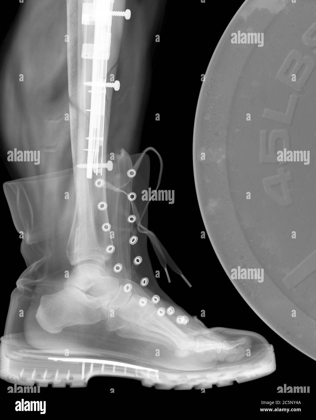 Xray for broken leg immagini e fotografie stock ad alta risoluzione Alamy
