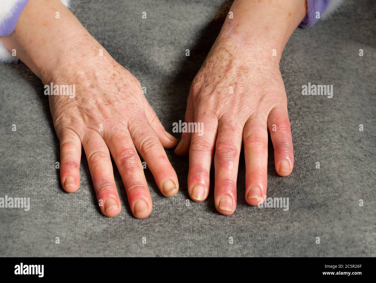 Mani di una donna di 60 anni con sindrome di Raynaud Foto Stock