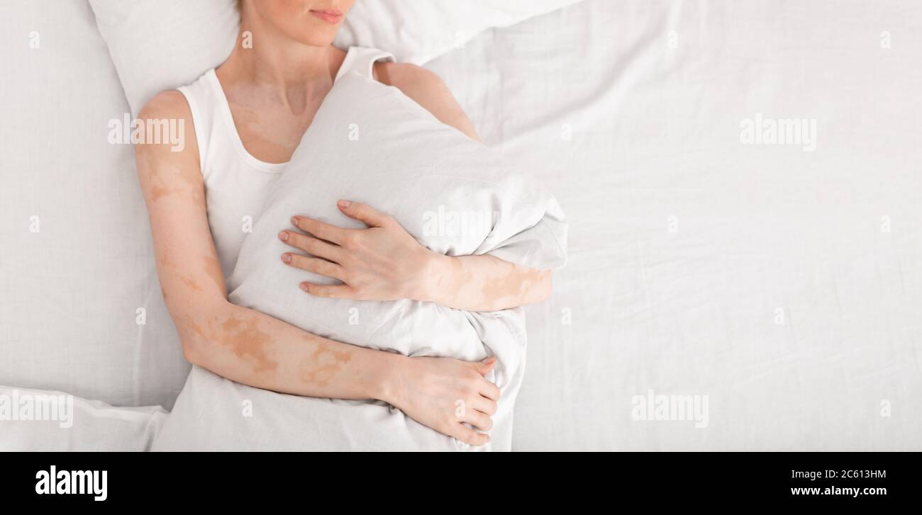 Donna con vitiligine sdraiata in letto matrimoniale e cuscino avvolgente Foto Stock