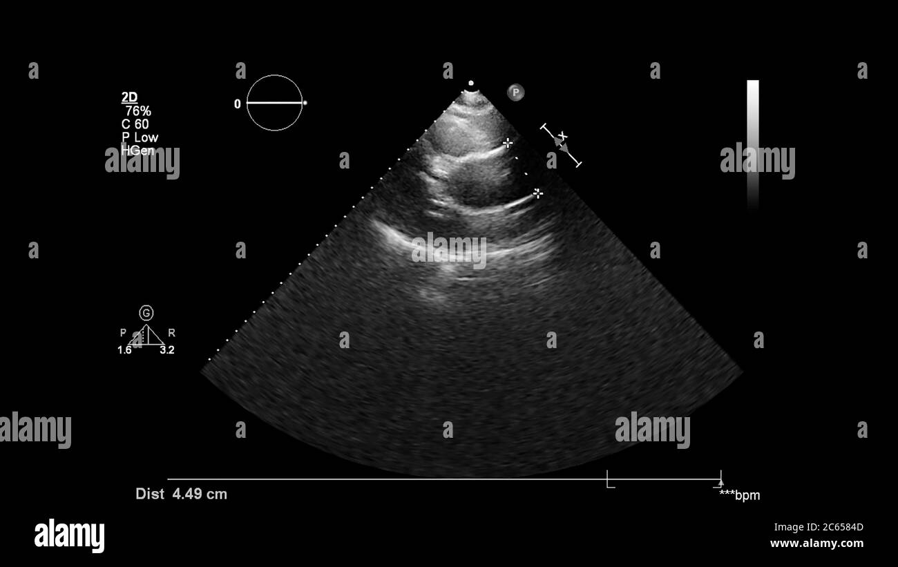 Immagine del cuore in modalità scala di grigi durante l'ecografia transesofagea. Foto Stock