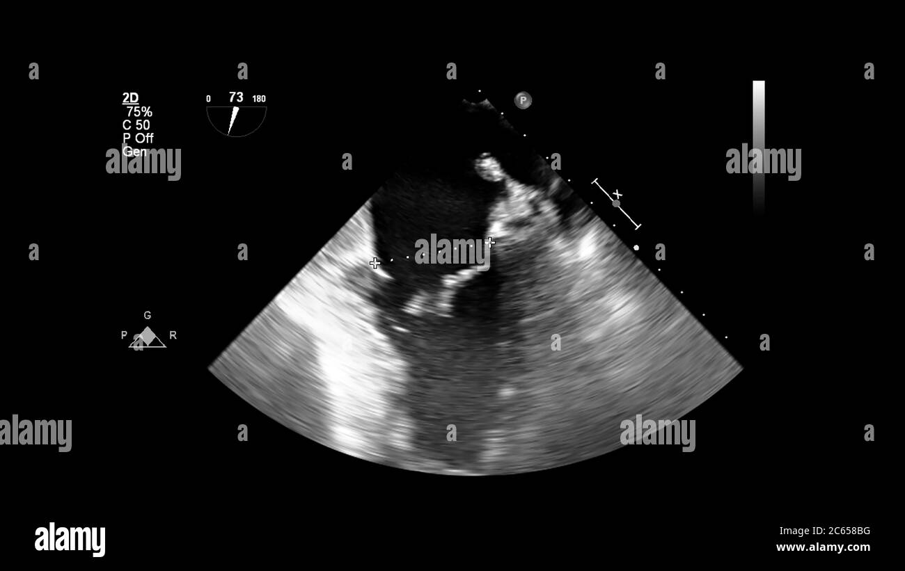 Immagine del cuore in modalità scala di grigi durante l'ecografia transesofagea. Foto Stock