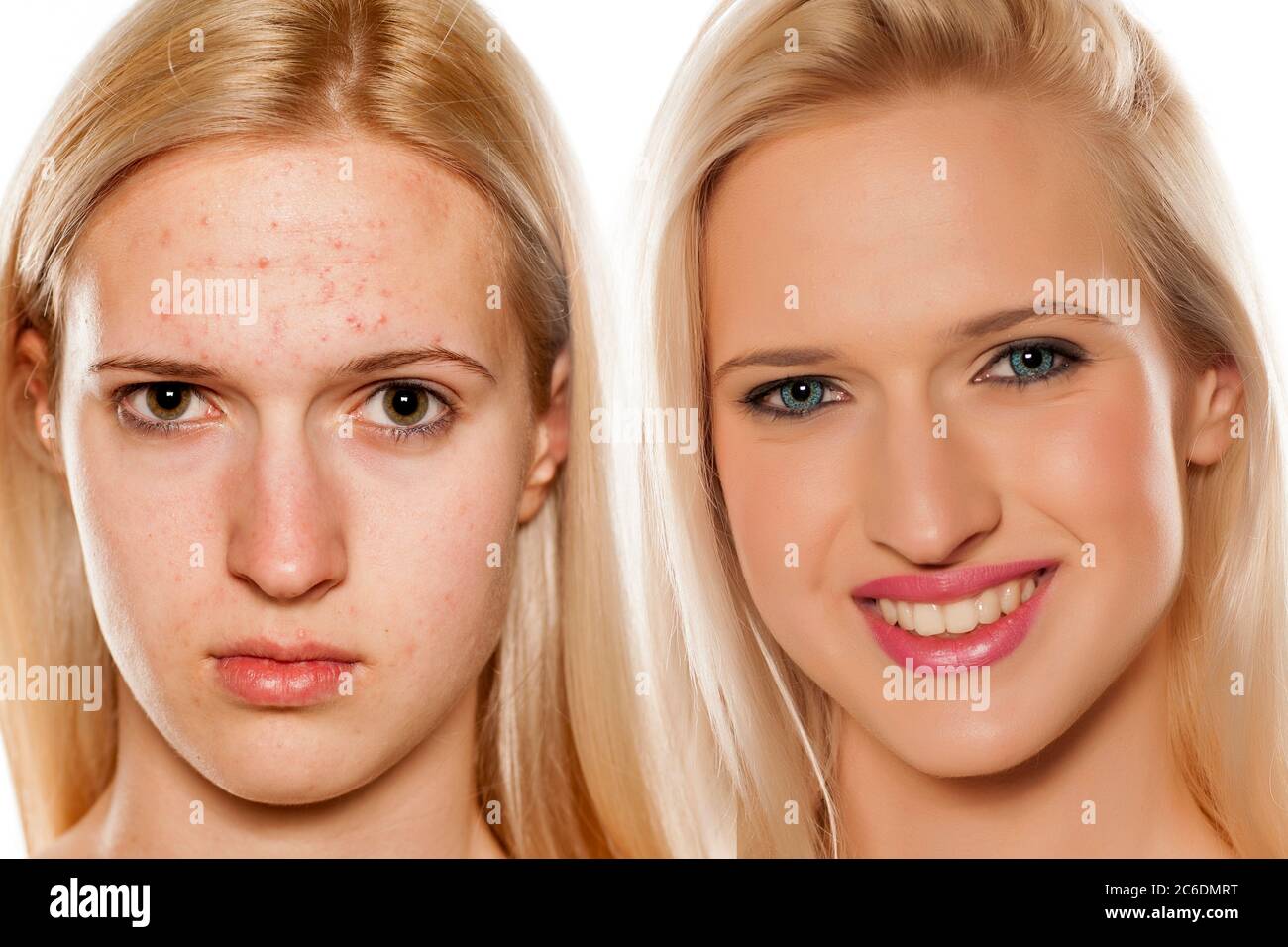 Ritratto comparativo del viso femminile, prima e dopo il trattamento cosmetico Foto Stock