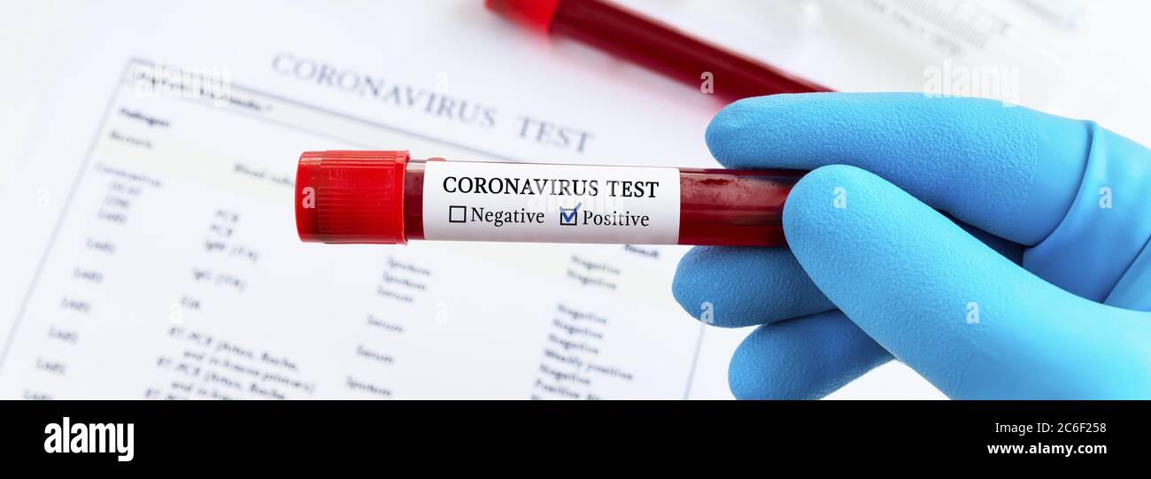 Panorama di Coronavirus test. Il medico ha a portata di mano un guanto medico che tiene la provetta con sangue positivo Coronavirus sopra la scrivania del laboratorio. Foto Stock