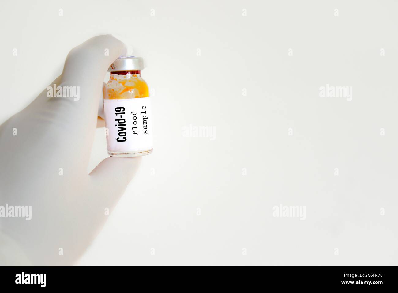 Flacone contenente un campione di sangue per l'analisi della micidiale covid19 diaease. Foto Stock