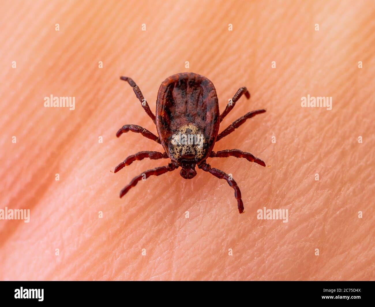 Virus dell'encefalite o borelliosi di Lyme malattia infettiva Tick Dermacentor aracnide insetto parassita sulla pelle Macro Foto Stock