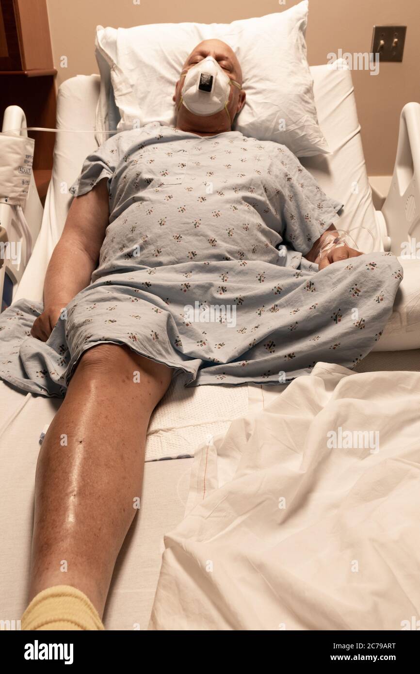 L'uomo in un letto d'ospedale addormentato indossando un respiratore, amputato alle gambe, coronavirus, cancro, coaguli di sangue, aspetto verticale Foto Stock