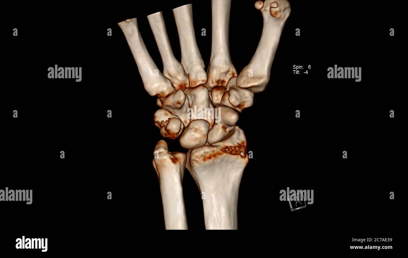Esame radiologico, tomografia computerizzata Volume rendering esame dell'articolazione del polso (polso TC VR) che mostra una frattura dell'osso scapoide Foto Stock