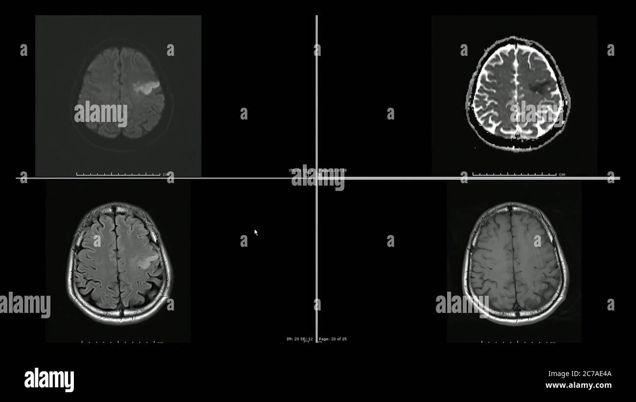 Immagini di risonanza magnetica (MRI) dell'infarto cerebrale nei tagli superiori del lobo frontale sinistro Foto Stock