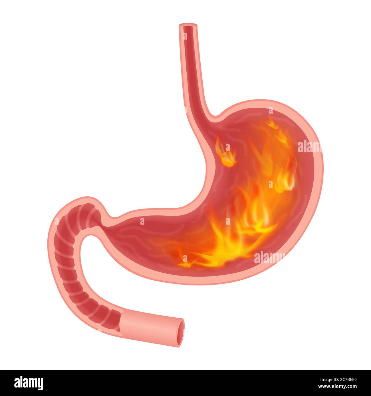 Illustrazione medica realistica di pirosi stomaco isolato. Disturbi del fuoco all'interno dello stomaco Illustrazione Vettoriale