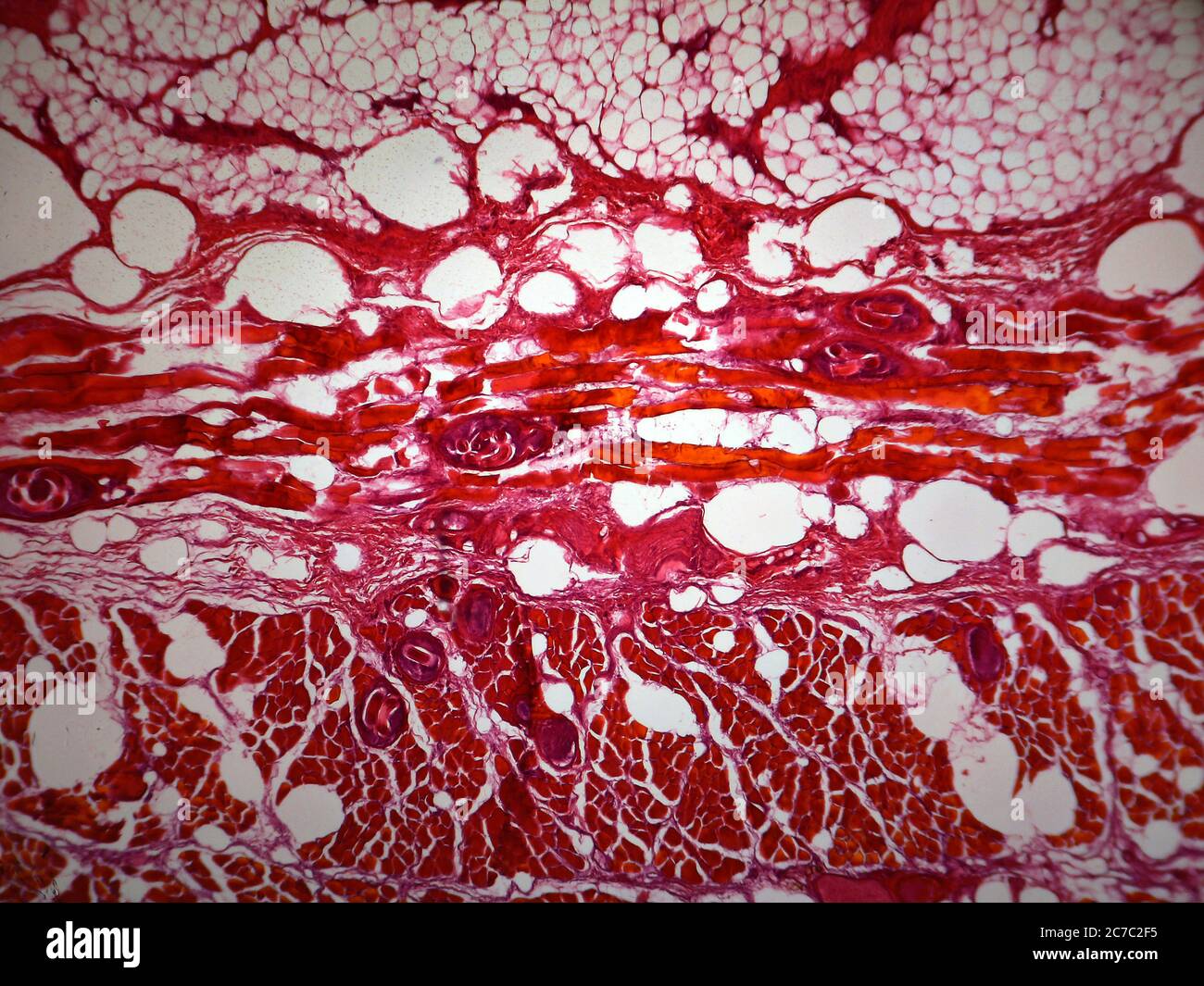 Microfotografia del tessuto parassitizzante della trichinosi. Trichinella sp. Foto Stock
