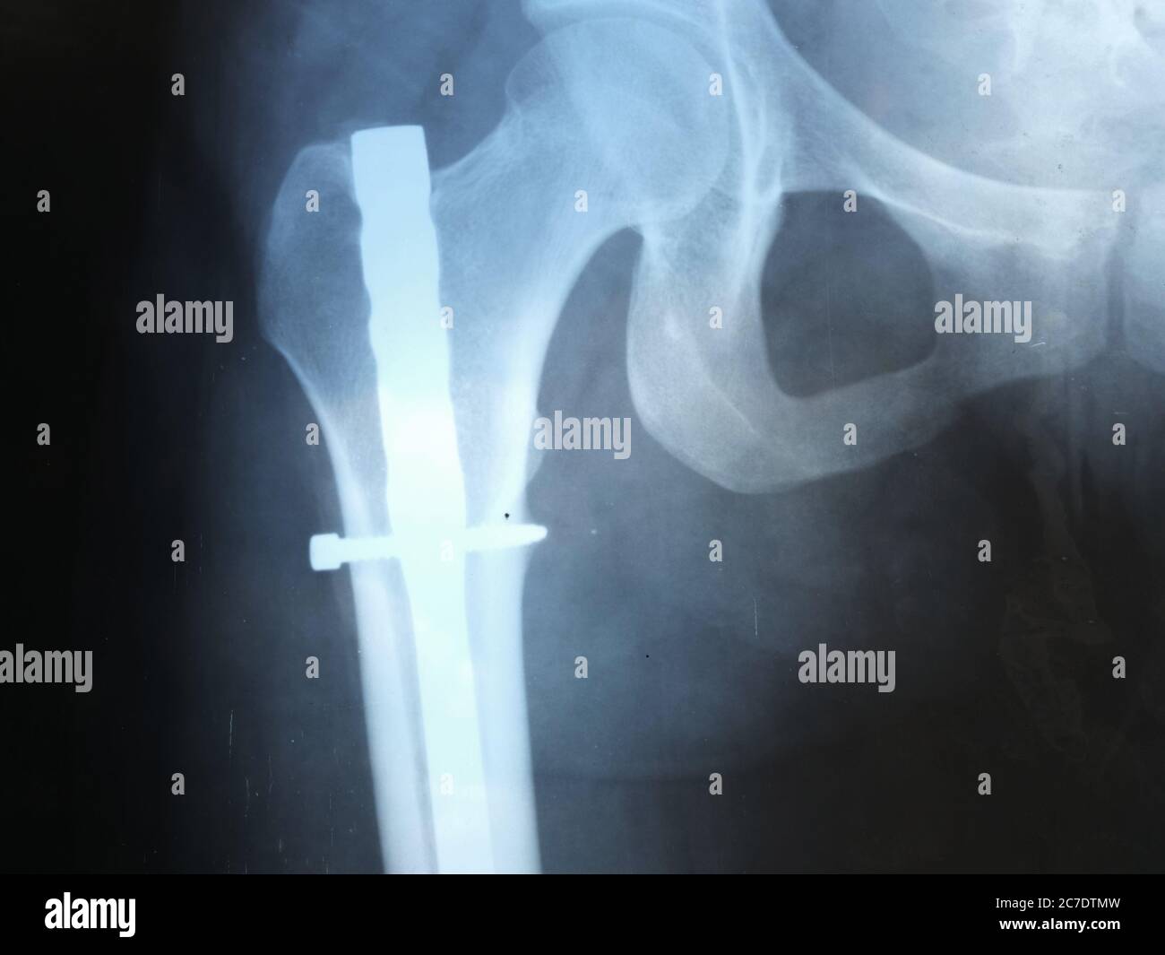 Questa foto di riserva mostra i raggi X di un femore dopo l'intervento chirurgico con l'aggiunta di un ago di ferro dopo una frattura Foto Stock