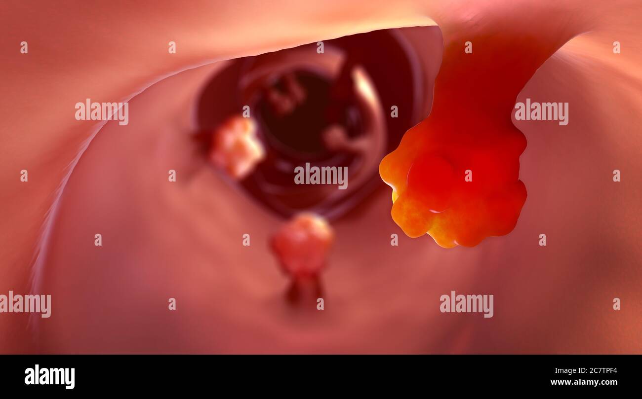 Vista ravvicinata dei polipi intestinali e del tessuto intestinale malato che può causare il cancro - illustrazione 3d Foto Stock