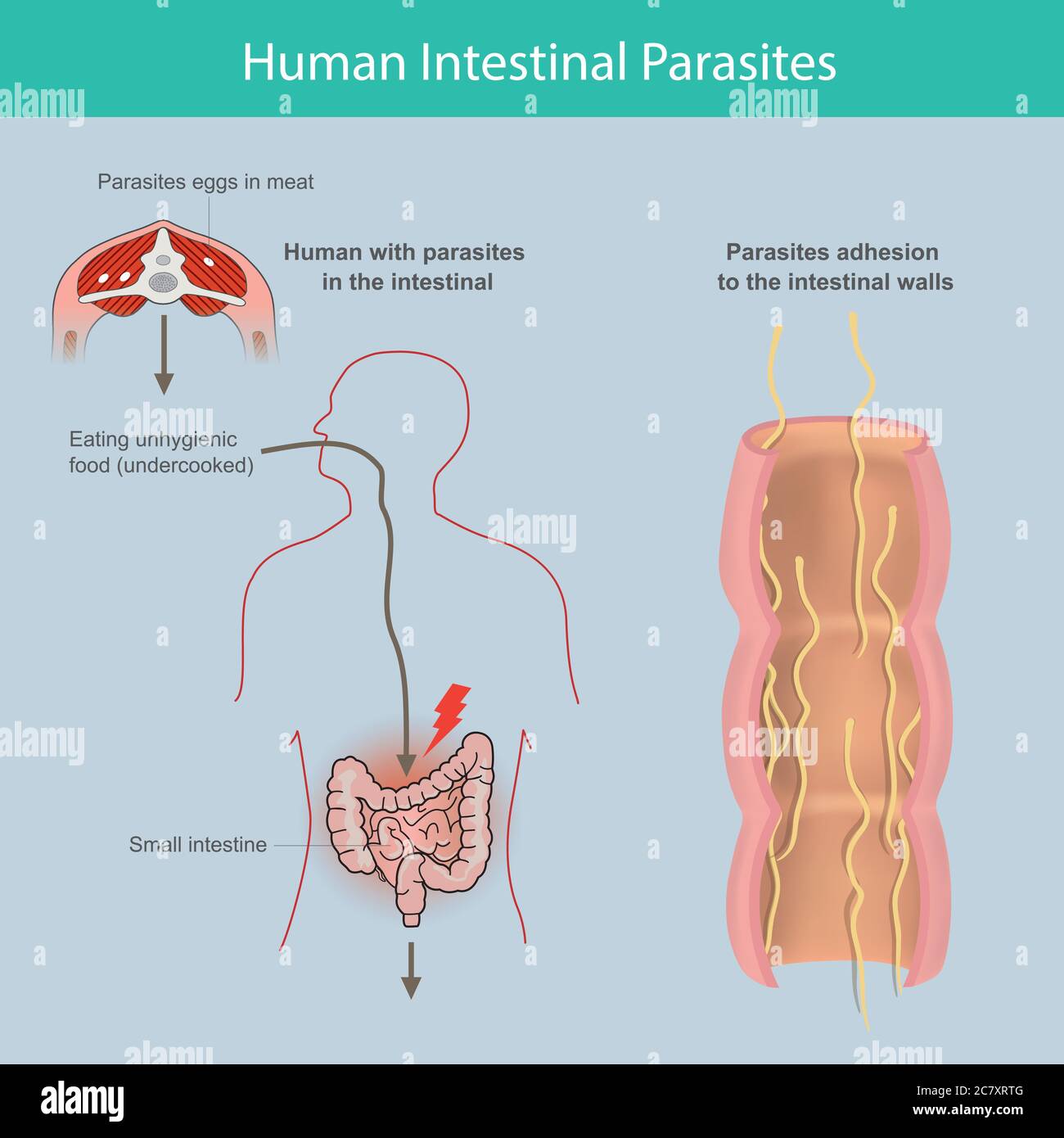 Parasiti intestinali umani. Illustrazione spiegare i parassiti nell'intestino tenue umano per causa di mangiare carne infetta o uova parassitarie nella carne Illustrazione Vettoriale