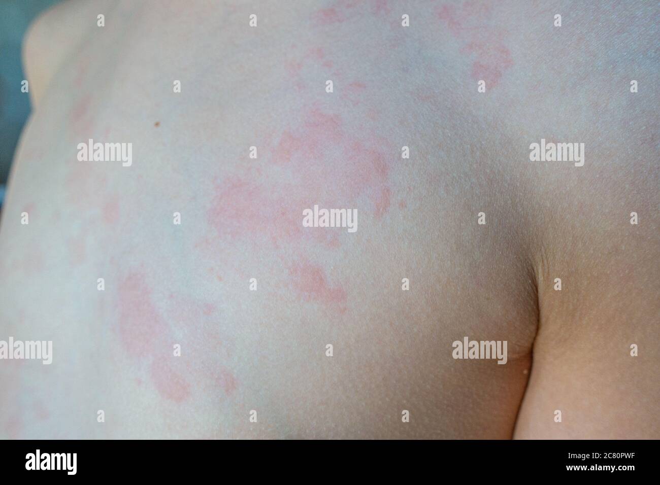 Un bambino si è rotto in orticaria, un'eruzione cutanea rossa arrabbiata in seguito a una reazione allergica. Foto Stock