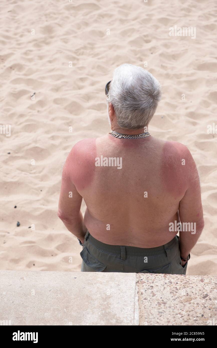Un uomo dai capelli grigi in piedi con la sua camicia su una spiaggia sabbiosa con scottature sulla schiena e sul collo a forma di gilet che indossava. Foto Stock