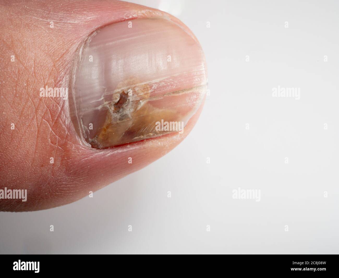 Infezioni delle unghie causate da funghi quali: Onicomicosi nota anche come tinea unguium. Infezione del pollice Foto Stock