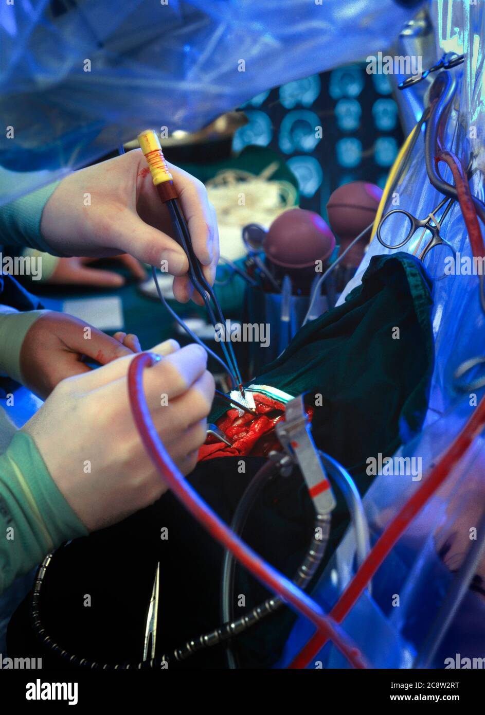 Chirurgia cerebrale elettrochirurgica Foto Stock