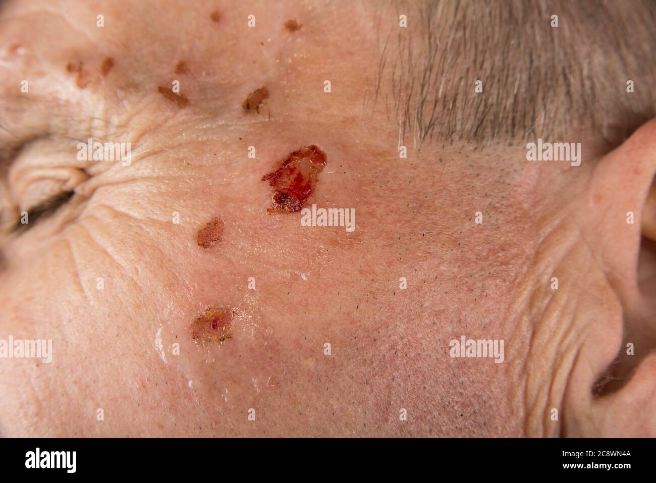 Ferita dal laser su un viso da dermatologo Foto Stock
