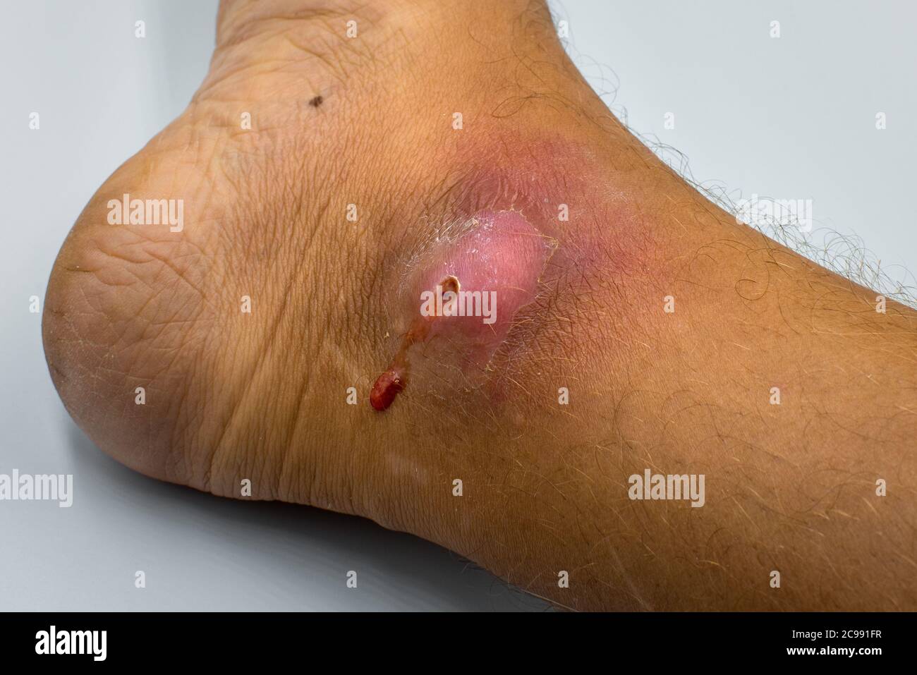 Ascessi si formano dopo batteri. Infetto purulento ferita aperta sul piede dell'uomo. Foto Stock
