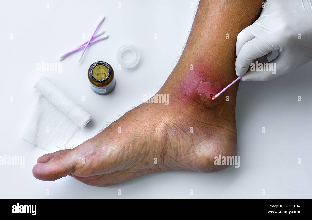 L'infermiere pulisce la ferita purulenta infetta sul piede del paziente. Cura e medicazione delle ferite. Foto Stock