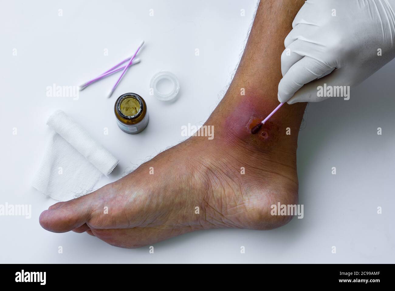 Medico che applica la medicina alla ferita infetta sul piede del paziente. Foto Stock
