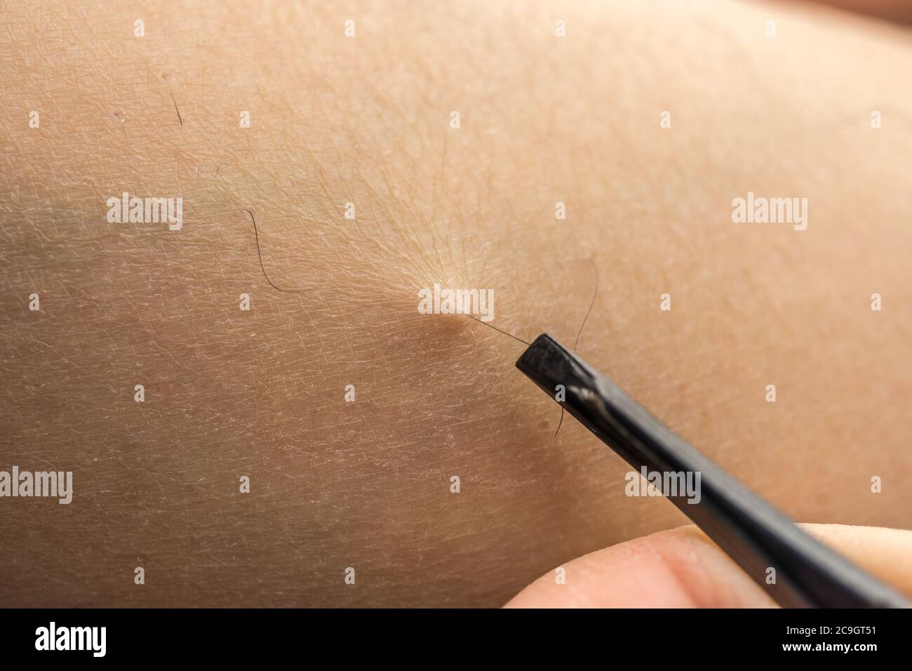 primo piano dettaglio della donna utilizzando un paio di pinzette, rimuovendo i capelli dalla gamba pelosa. Con problema di pelle secca Foto Stock