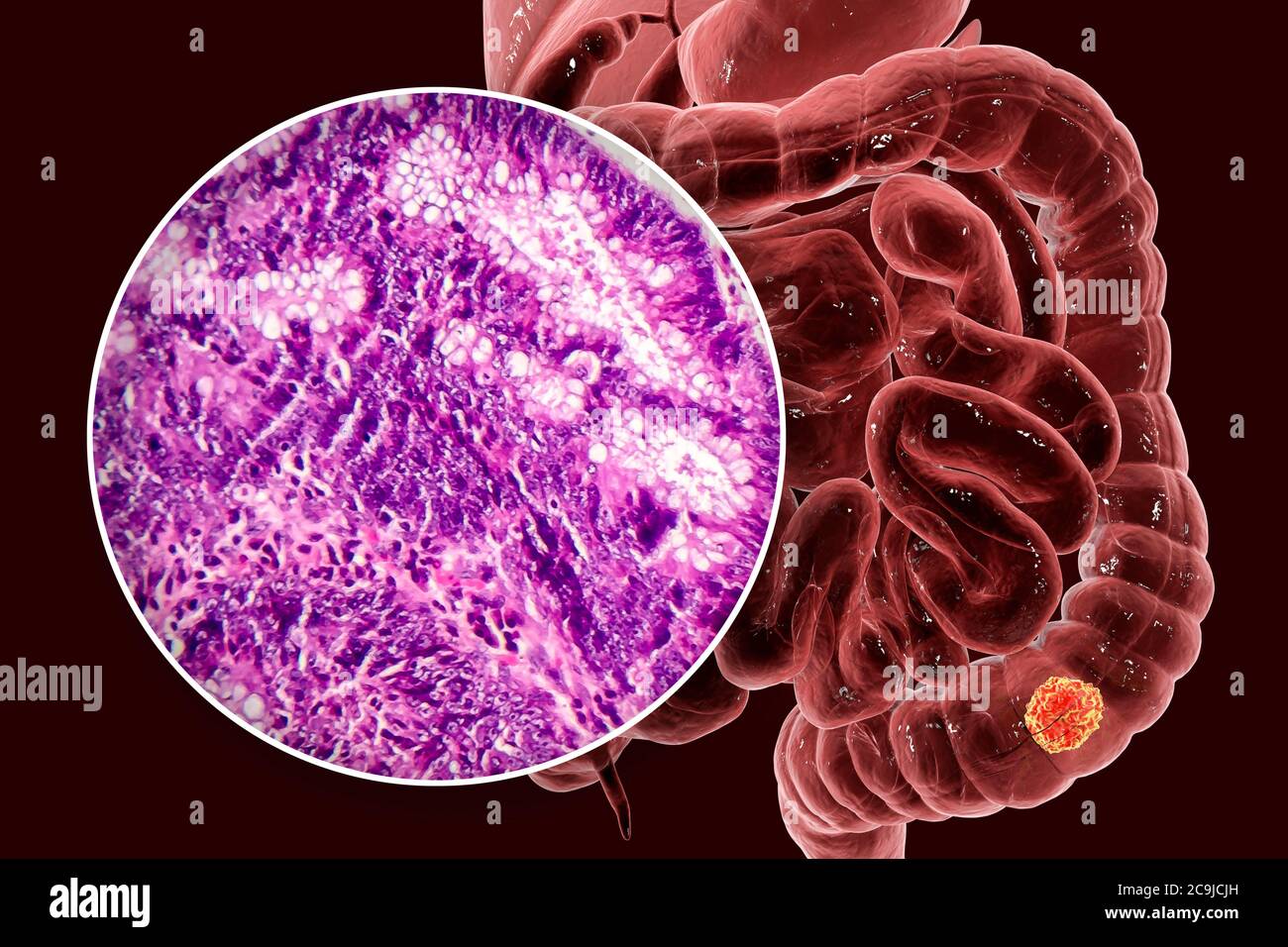Cancro del colon, illustrazione del computer e micrografia leggera che mostra l'adenocarcinoma del colon. Foto Stock