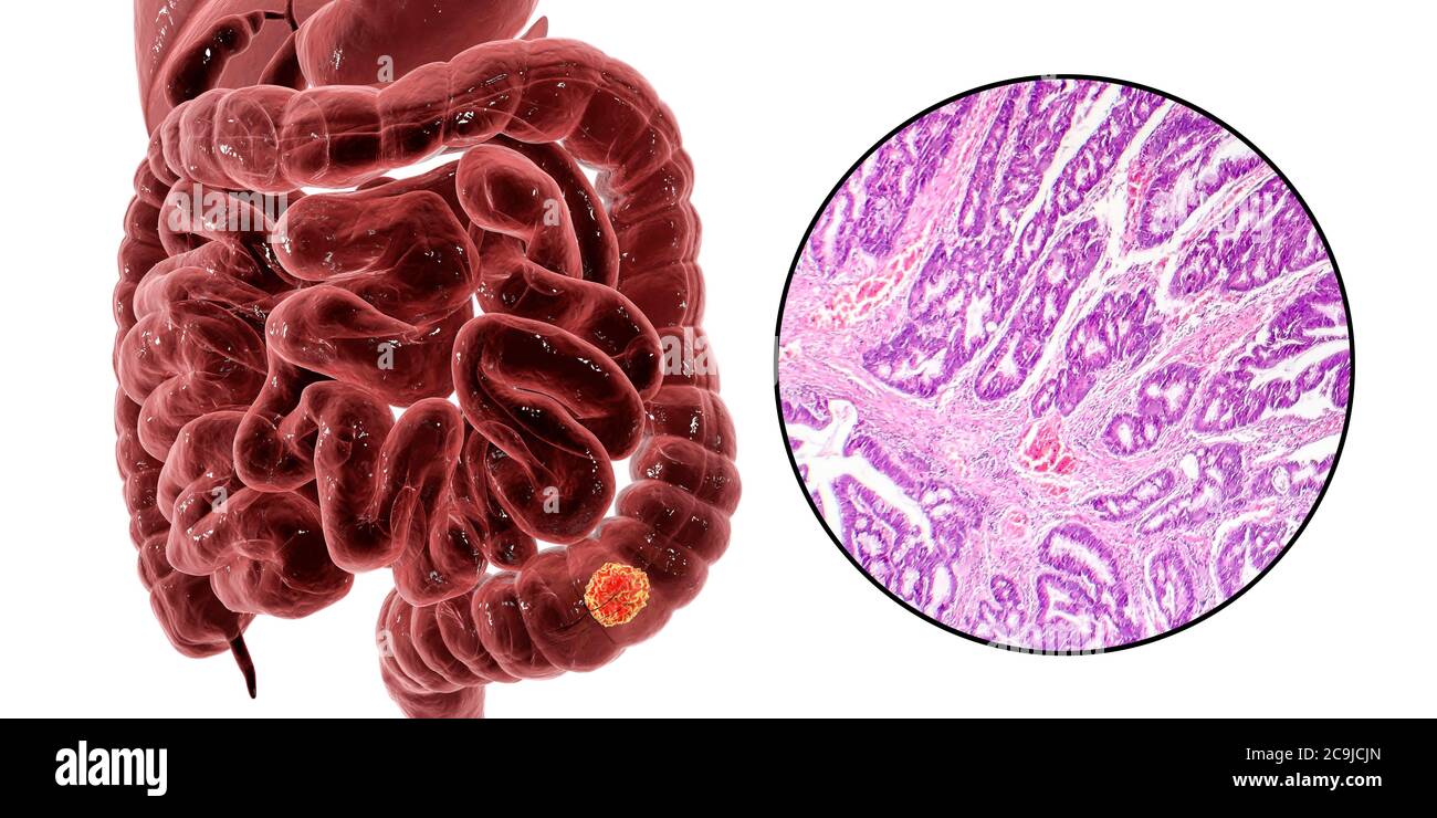 Cancro del colon, illustrazione del computer e micrografia leggera che mostra l'adenocarcinoma del colon. Foto Stock