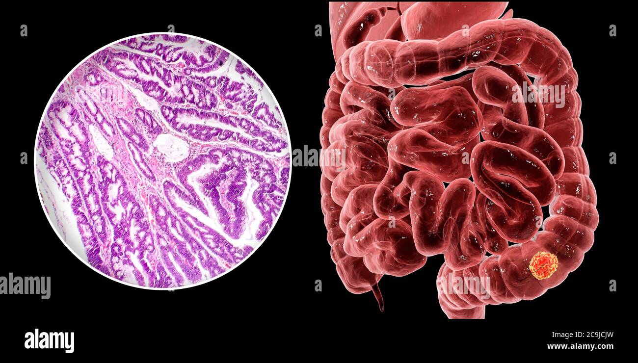 Cancro del colon, illustrazione del computer e micrografia leggera che mostra l'adenocarcinoma del colon. Foto Stock
