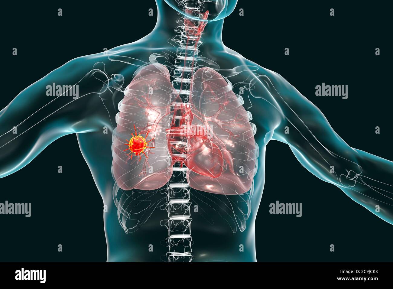 Cancro polmonare, illustrazione del computer che mostra un tumore maligno nel polmone. Foto Stock