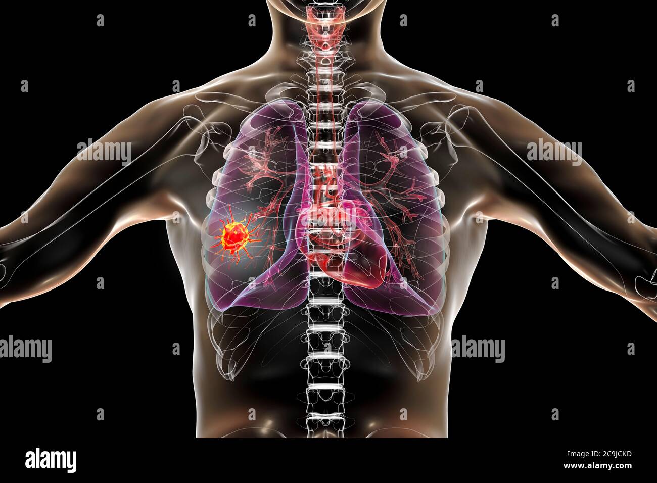 Cancro polmonare, illustrazione del computer che mostra un tumore maligno nel polmone. Foto Stock