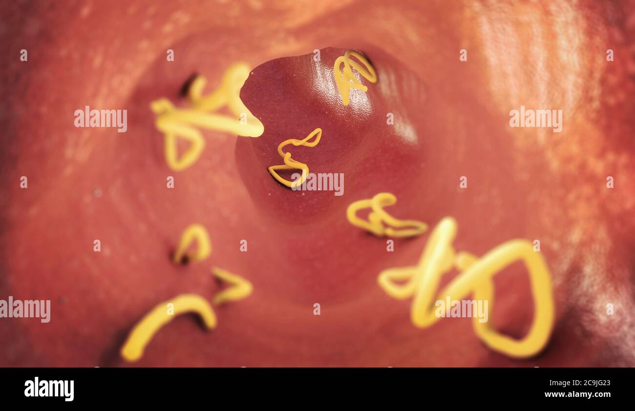 Infestazione di Tapeworm nell'intestino umano, illustrazione. Foto Stock