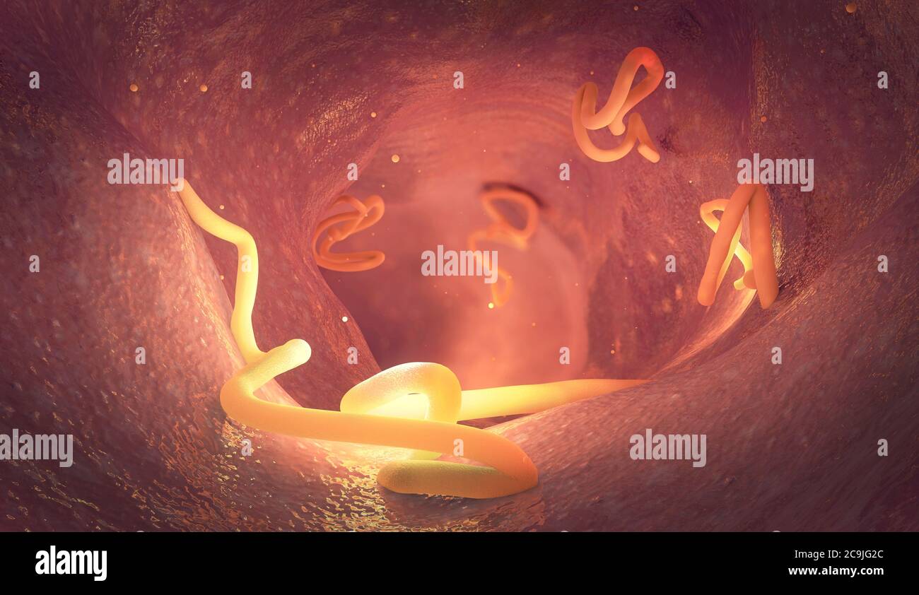Infestazione di Tapeworm nell'intestino umano, illustrazione. Foto Stock