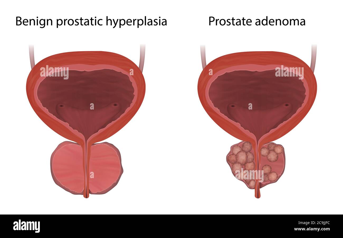 Confronto tra iperplasia prostatica benigna e adenoma prostatico