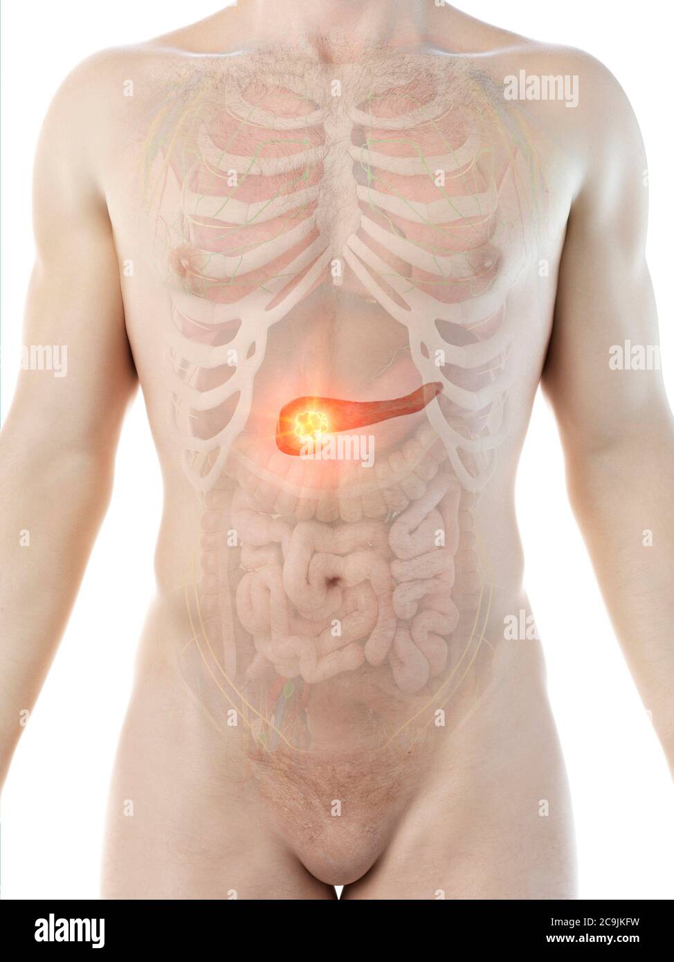 Il cancro pancreatico, concettuale illustrazione del computer. Foto Stock
