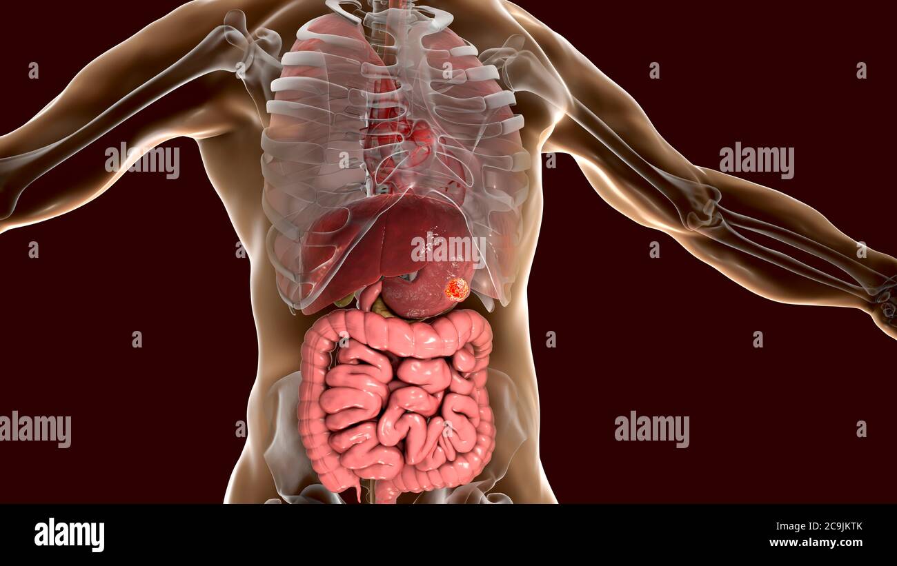 Stomaco umano cancro, illustrazione del computer. Foto Stock