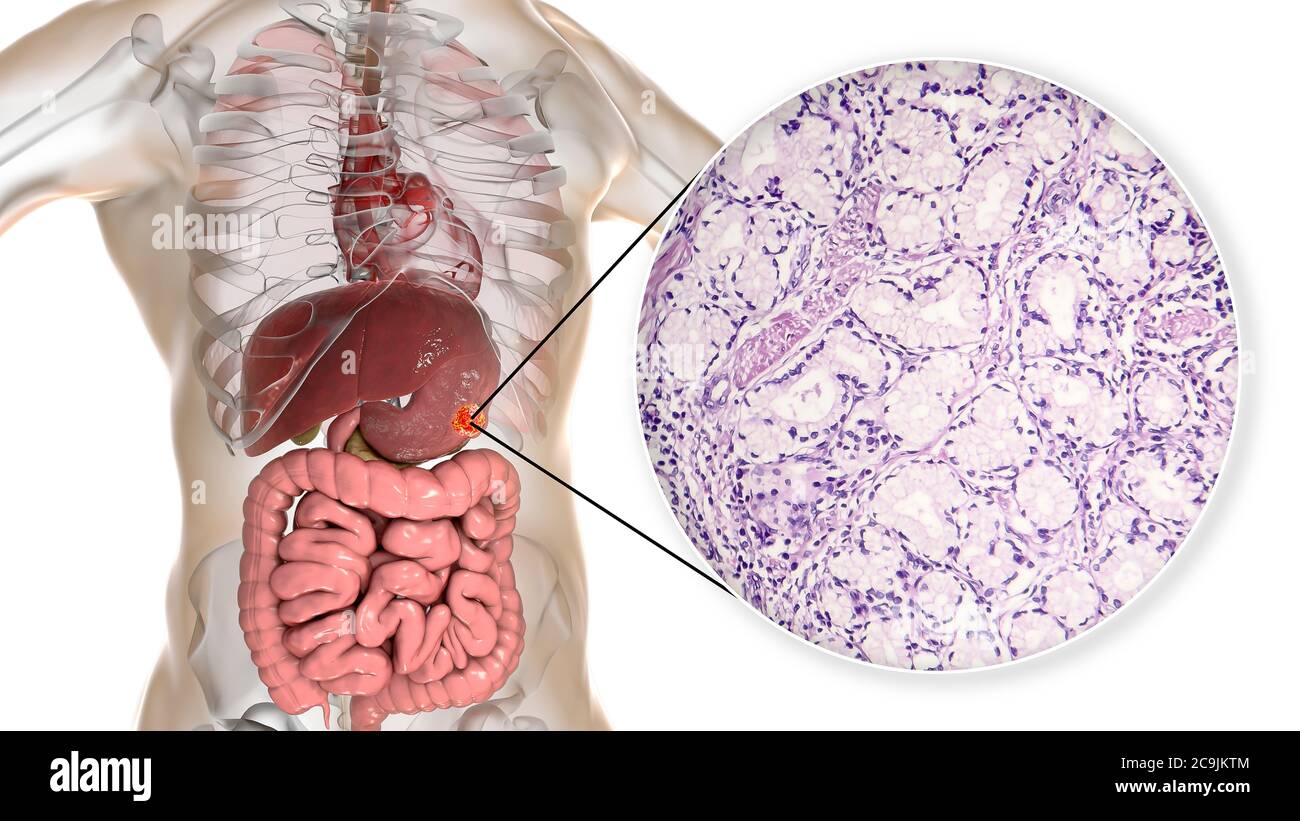 Adenocarcinoma mucoso dello stomaco umano, illustrazione del computer e micrografia leggera. Foto Stock Adenocarcinoma mucoso dello stomaco umano, illustrazione del computer e micrografia leggera. Foto Stock