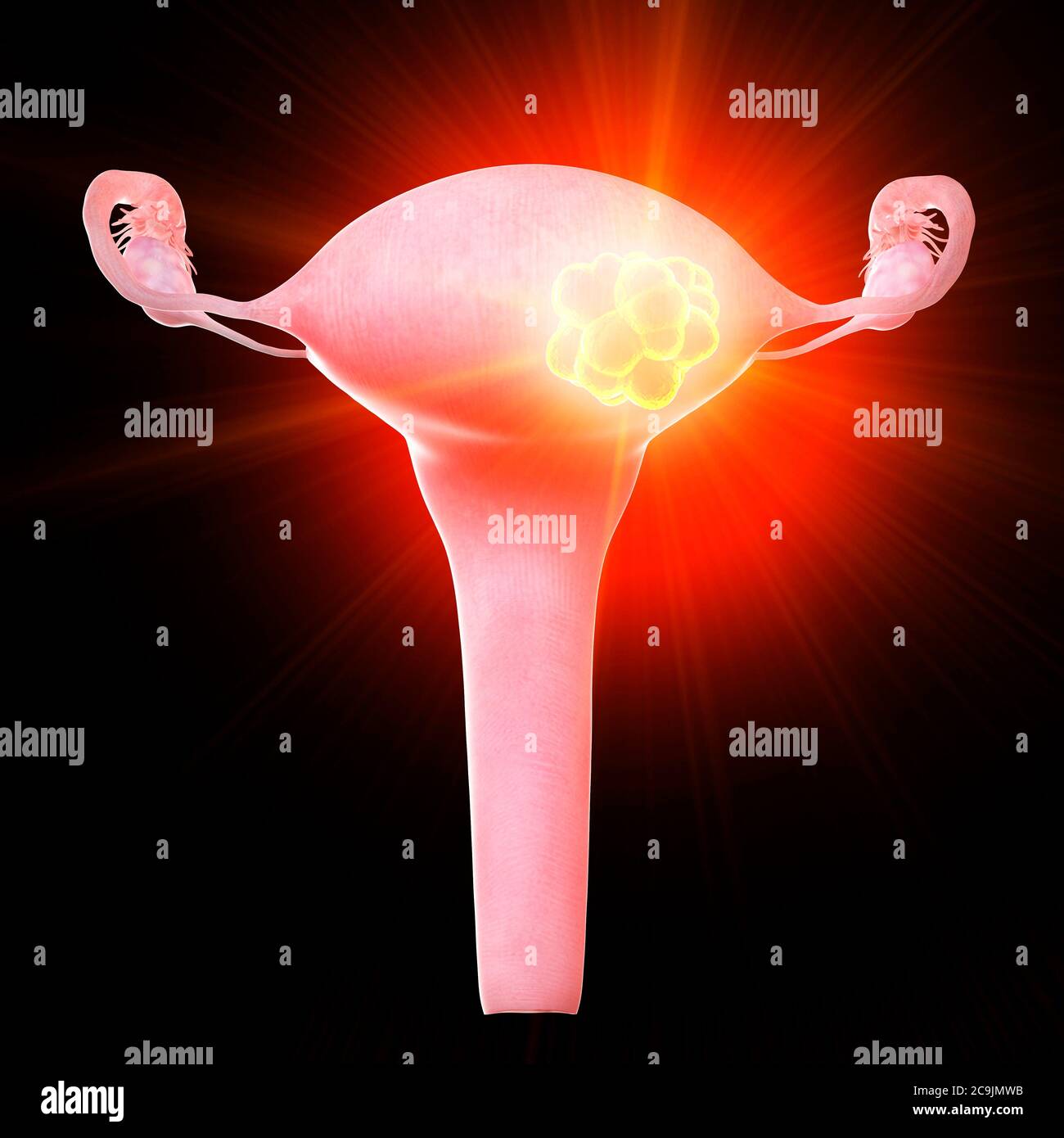 Tumore uterino, illustrazione concettuale del computer. Foto Stock