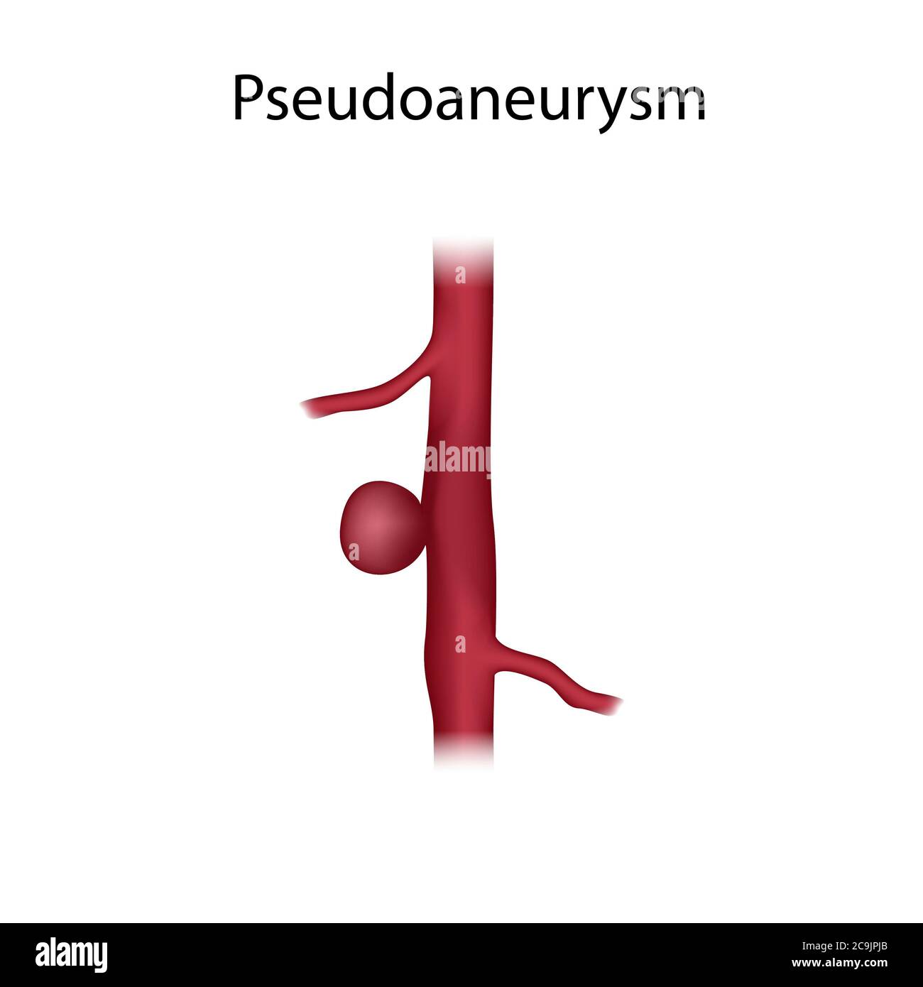 Pseudoaneurisma, illustrazione. Un aneurisma è una dilatazione del sangue  in un vaso sanguigno Foto stock - Alamy