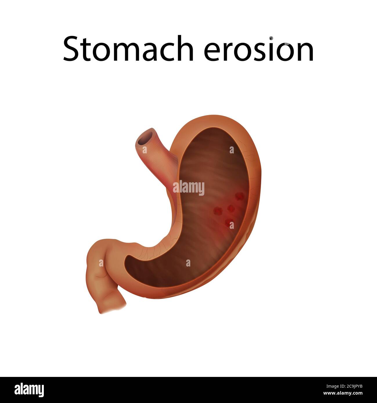 Erosione dello stomaco, illustrazione. Foto Stock
