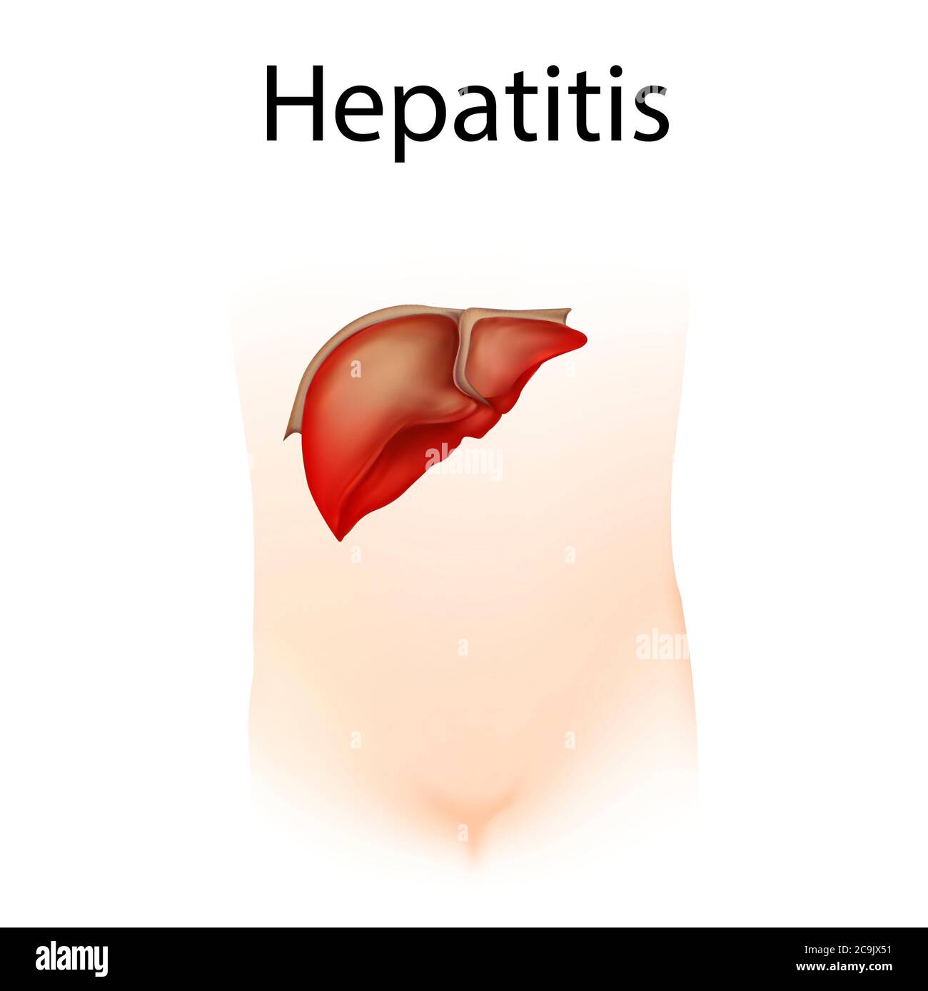 Epatite, illustrazione. L'epatite è l'infiammazione del fegato. Foto Stock