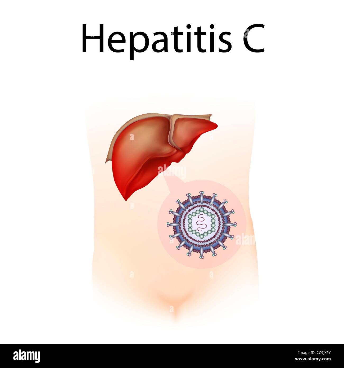 Epatite C, illustrazione. L'epatite è l'infiammazione del fegato. Foto Stock